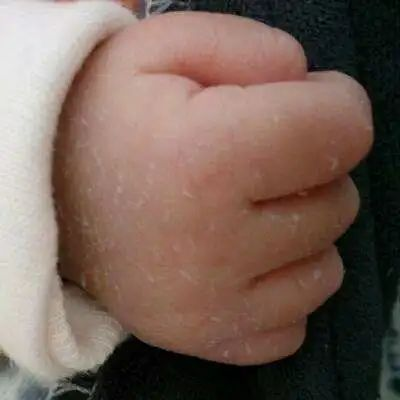 新生兒脫皮是正常的嗎？