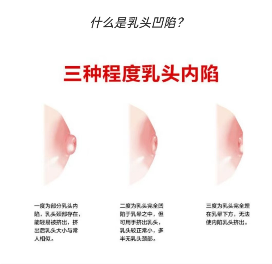 乳頭凹陷的媽媽該如何哺乳？